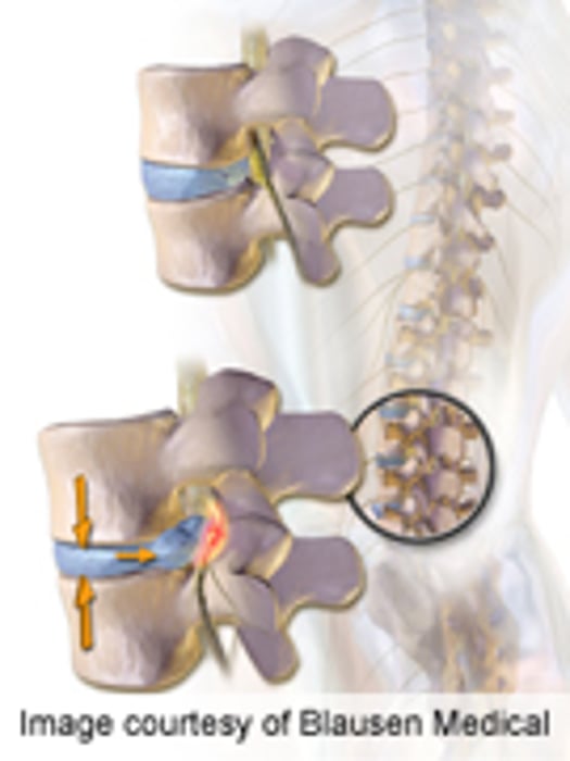 New Decision Aid for Treatment of Herniated Disc Beneficial