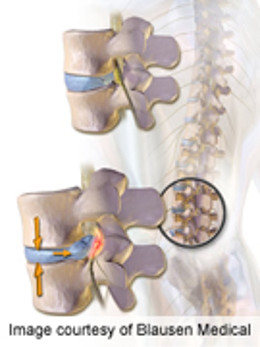 New Decision Aid for Treatment of Herniated Disc Beneficial