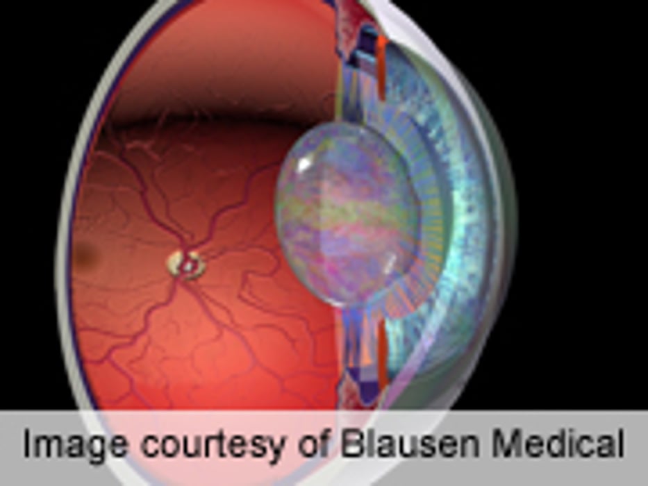 Cataract Risk Up for Statin Users With Type 2 Diabetes