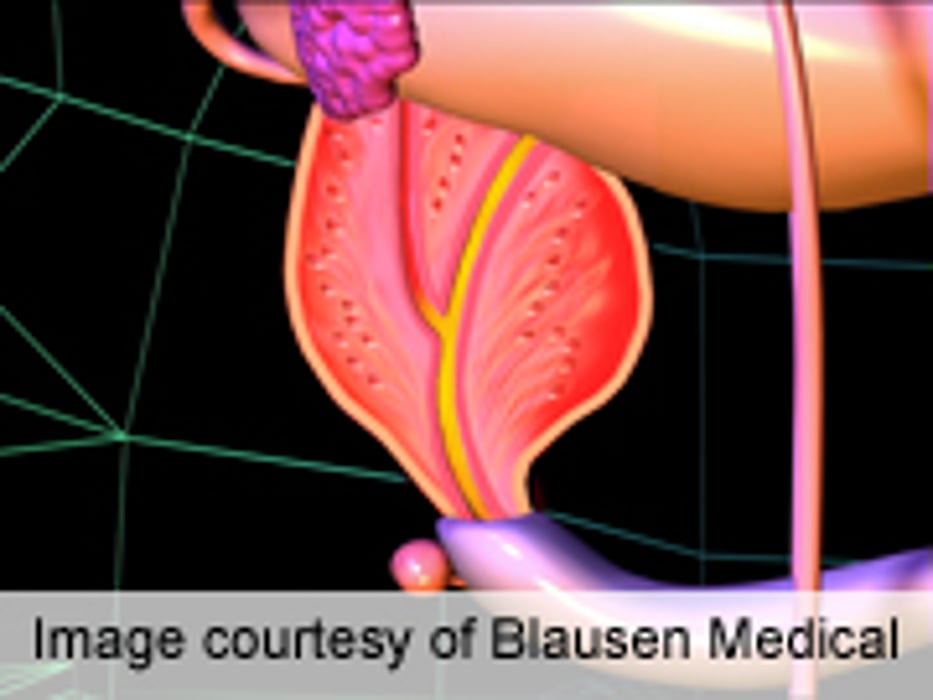 PSA Change After 5α Reductase Therapy Aids Cancer Diagnosis