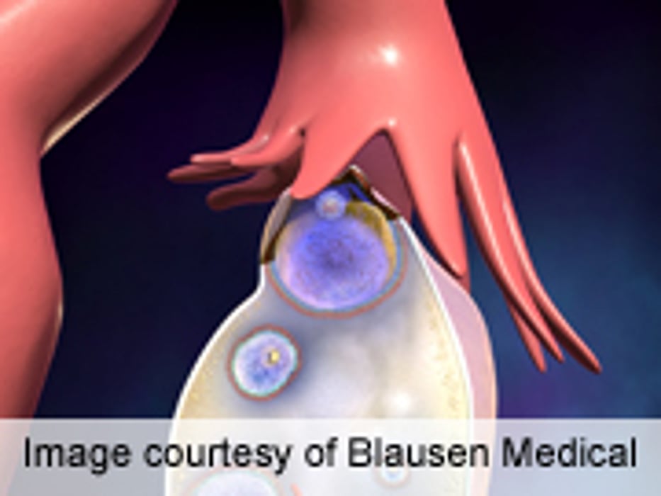 Simple Form Identifies Ovarian Cancer Warning Signs