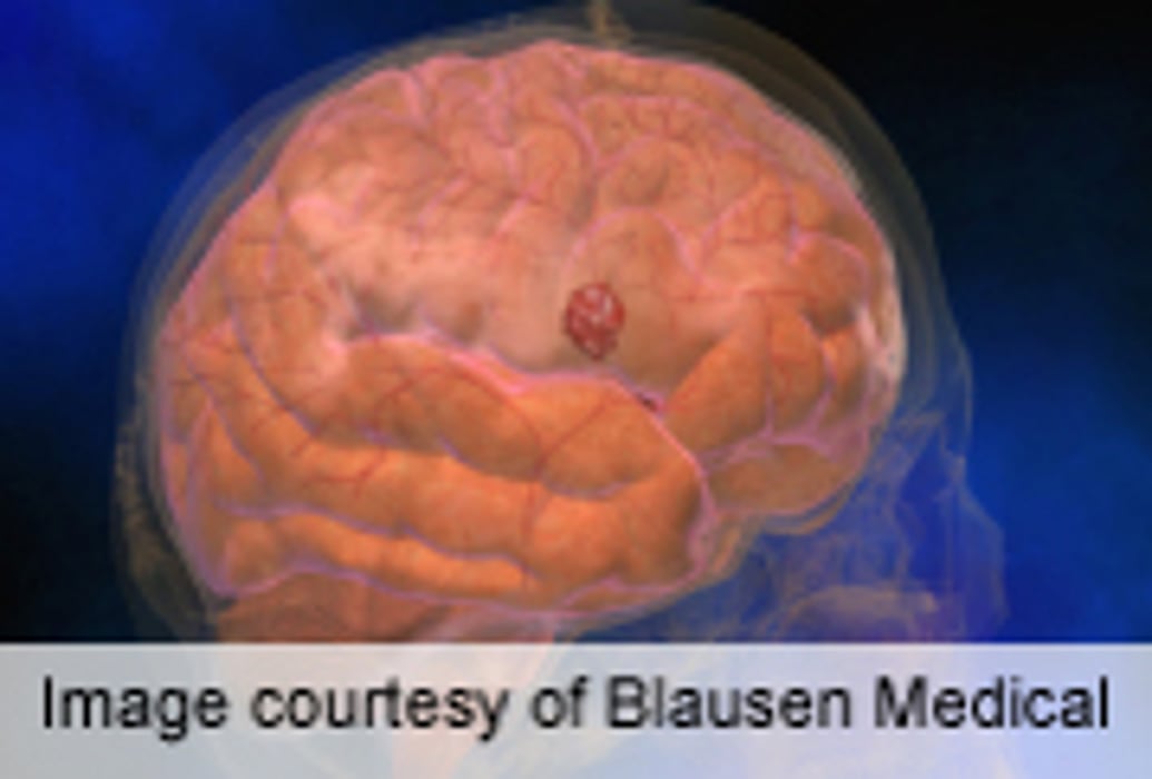 Pregnancy Ups Bleed Risk From Abnormal Brain Blood Vessels