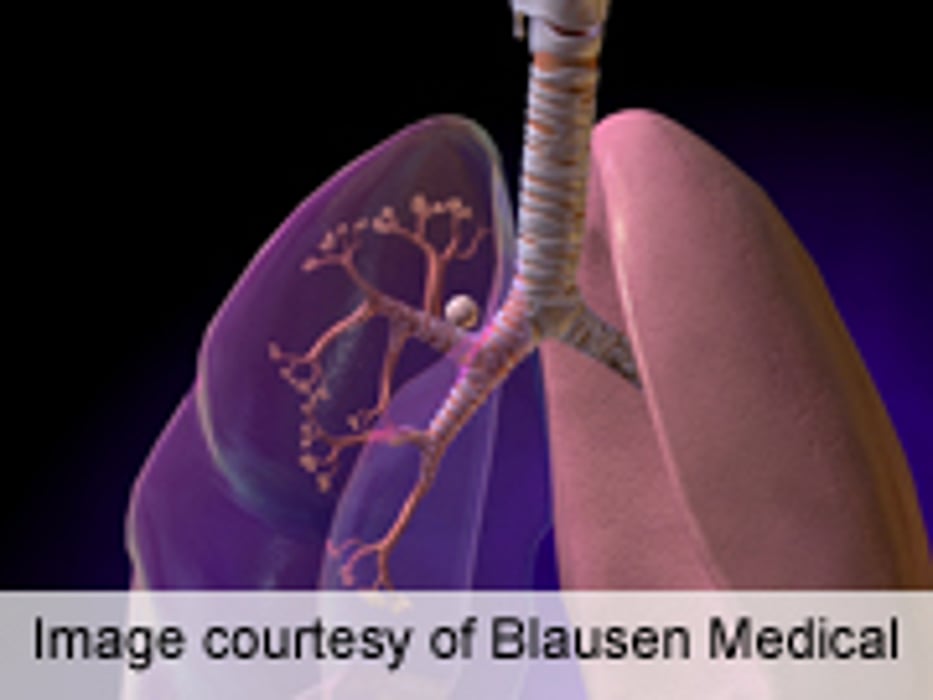 Lung Cancer Risk Unaffected by Metformin Use in Diabetes