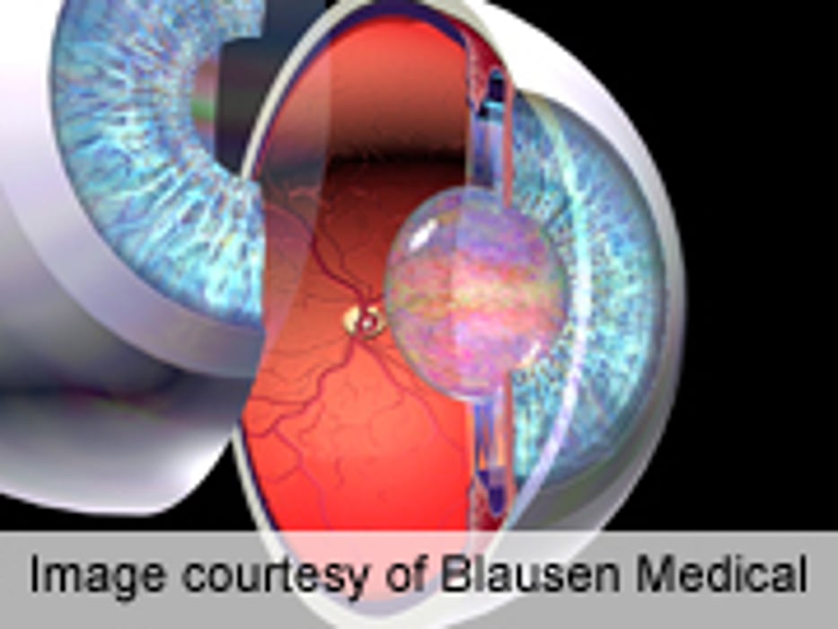 Lower Glaucoma Risk for Statin Users With Hyperlipidemia