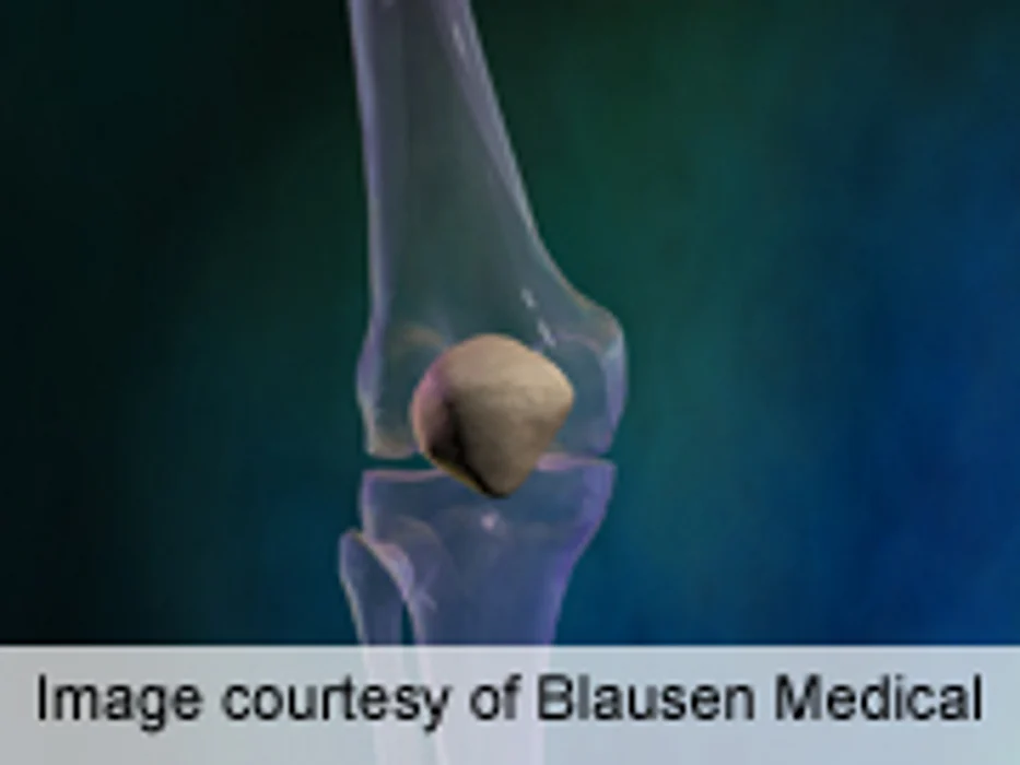 AAOS: Same-Day Double Knee Replacement Safe With RA
