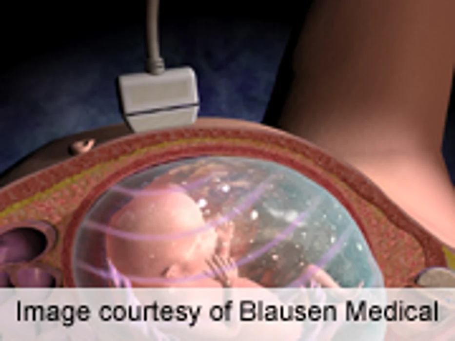 Single Progesterone Test Can Rule Out Viable Pregnancy