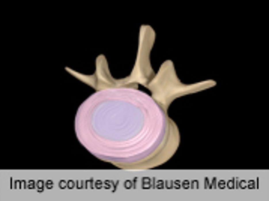 Gene ID'd With Possible Role in Disc Degeneration