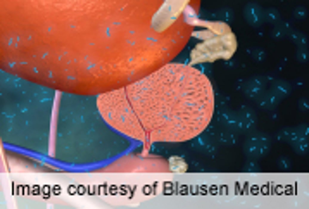 Reduced Penile Size Linked to Prostate Cancer Treatment