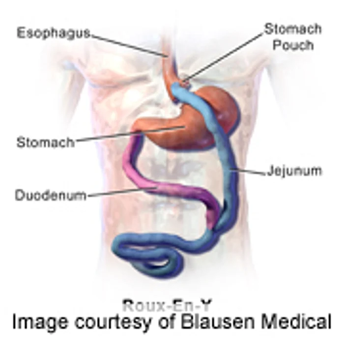 Weight-Loss Surgery Is New Diabetes Foe