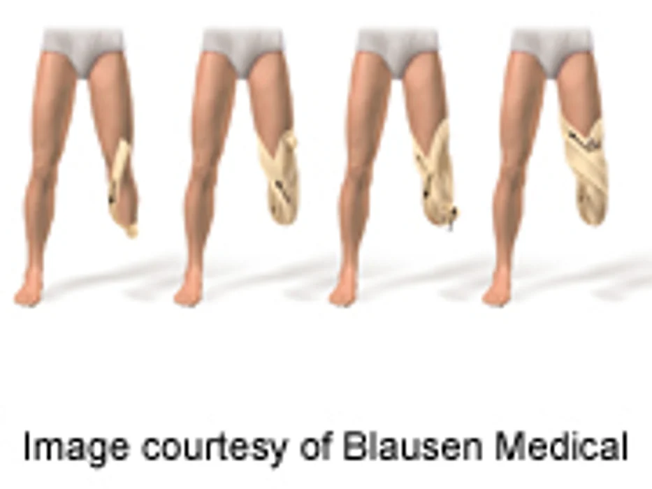 Lower-Extremity Amputations in Diabetes Down in Scotland