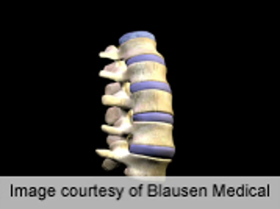 Alendronate Reduces Adjacent-Level Vertebral Fractures