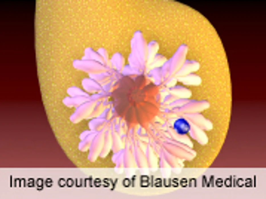 Patient Navigation Speeds Breast Cancer Diagnosis