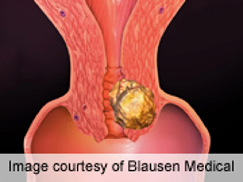Lexatumumab Tolerated for Pediatric Solid Tumors