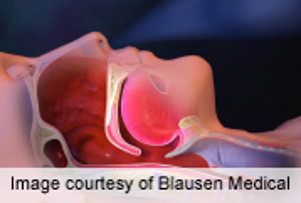 Treating Obstructive Sleep Apnea Tied to Lasting BP Drop