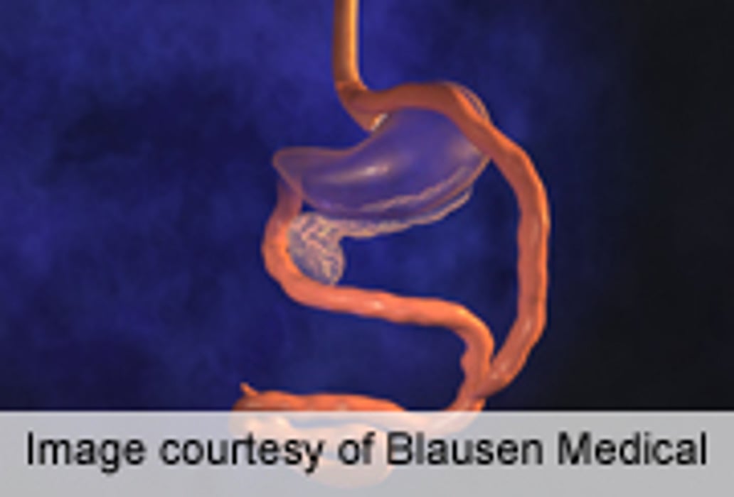 Effects of Bariatric Surgery on Heart Function, Structure ID'd