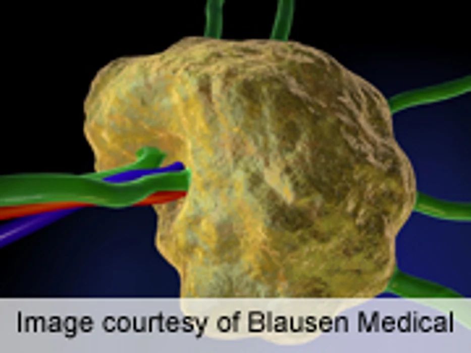 Neurocognitive Deficits Seen in Survivors of Pediatric Hodgkin's