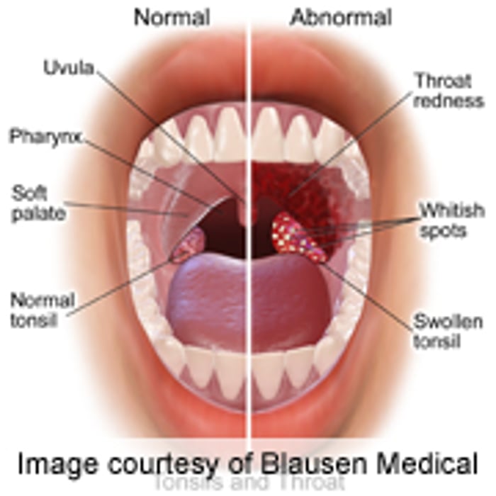 human papillomavirus infection in throat