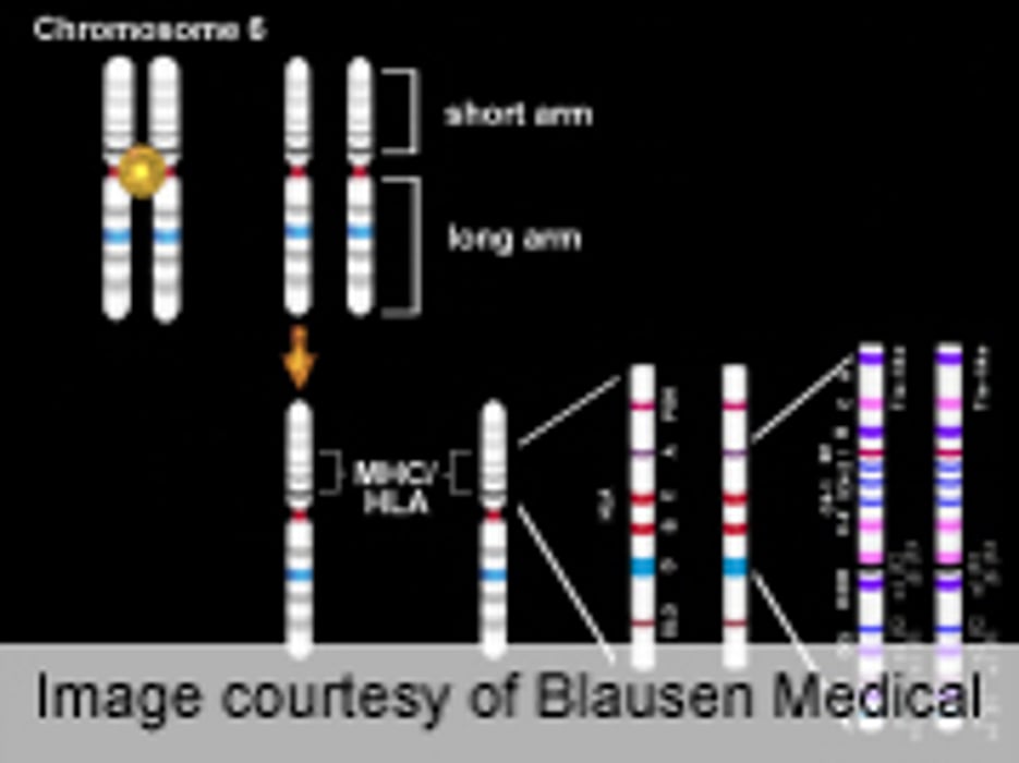 Genomic Alterations ID'd in Lung Squamous Cell Carcinoma