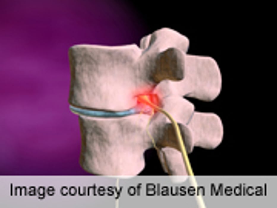 Use of BMP Doesn't Impact Nonunion Rates Post Spine Fusion