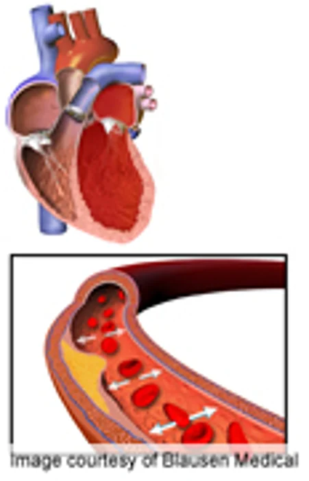 Low Diuretic Use in Home Care for Blacks With Hypertension