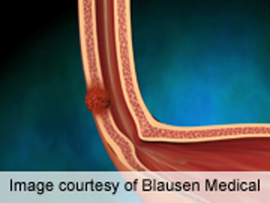 Symptoms Cluster After Esophageal Cancer Surgery