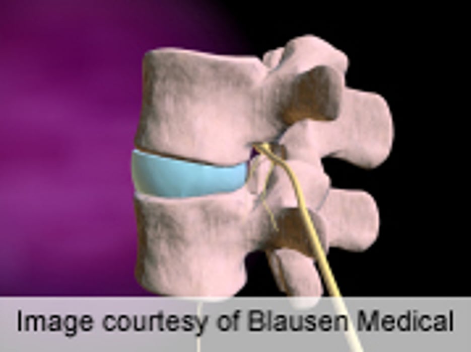 Tests Don't Predict Outcome After Spine Fusion for Back Pain