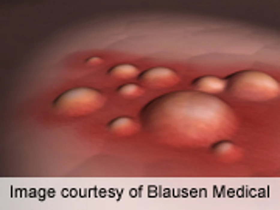 Primrose Oil Borage Oil Not Effective Eczema Treatment