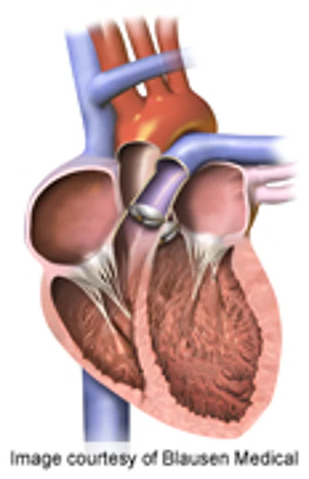 Trastuzumab Ups Cardiac Risk for Older Women With Breast Cancer