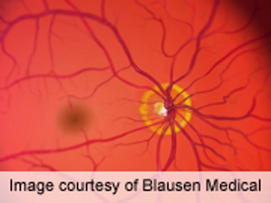 Bevacizumab Safe for Use in Tx of Macular Degeneration
