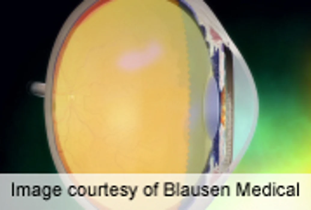 AAO: Microstent Cuts Intraocular Pressure in Glaucoma