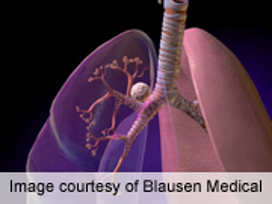Hospital Resection Volume Tied to NSCLC Survival in England