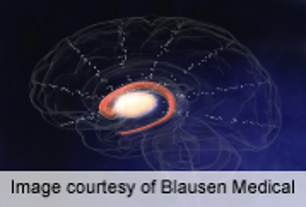 Neurostimulation Benefits Early Parkinson's Disease