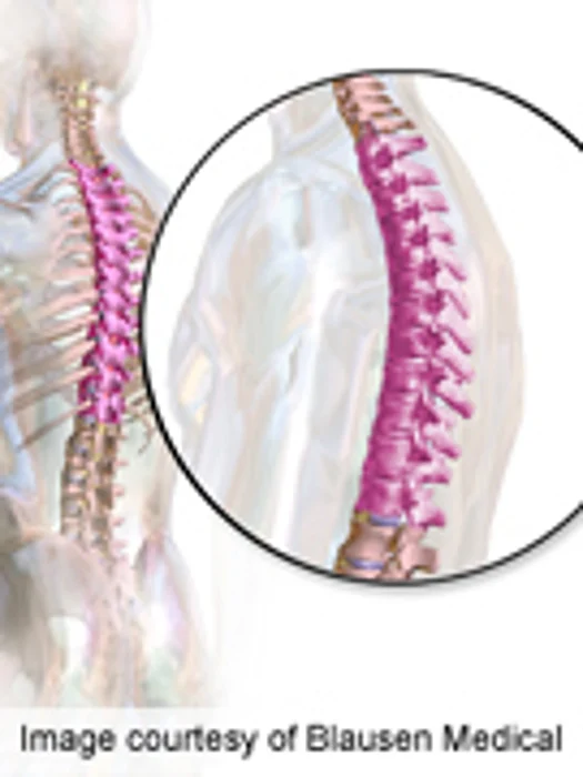Novel Device Benefits Type 3 Osteogenesis Imperfecta