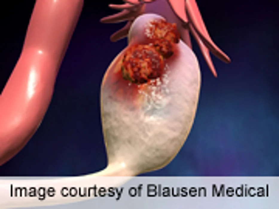 MiRNA Expression Reprograms Fibroblasts in Ovarian Cancer