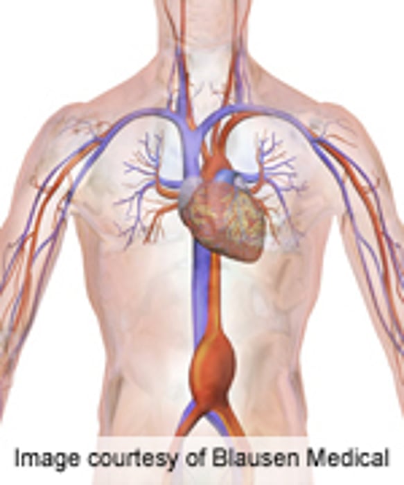 USPSTF: Draft Recommendations Issued for AAA Screening