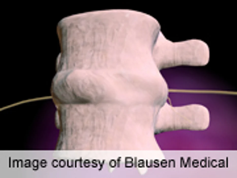 Worse Outcomes for Early Post-Lumbar Spinal Fusion Rehab