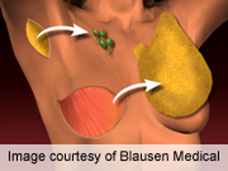 ASCO: Contralateral Prophylactic Mastectomy Is Overused