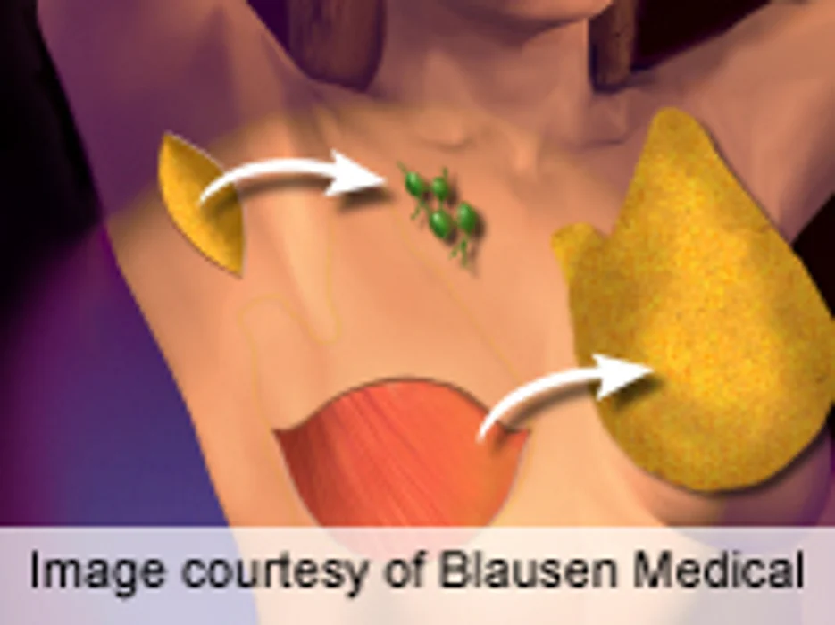 Most Women Who Choose Double Mastectomy Don't Need To, Study Shows