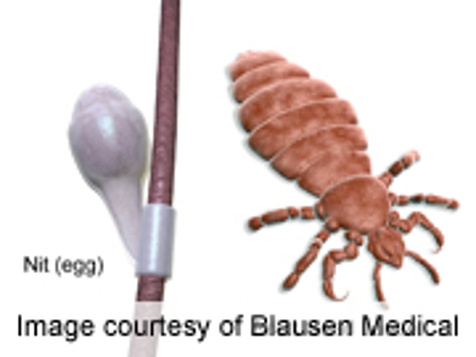 Expert Tips to Get Rid of Head Lice