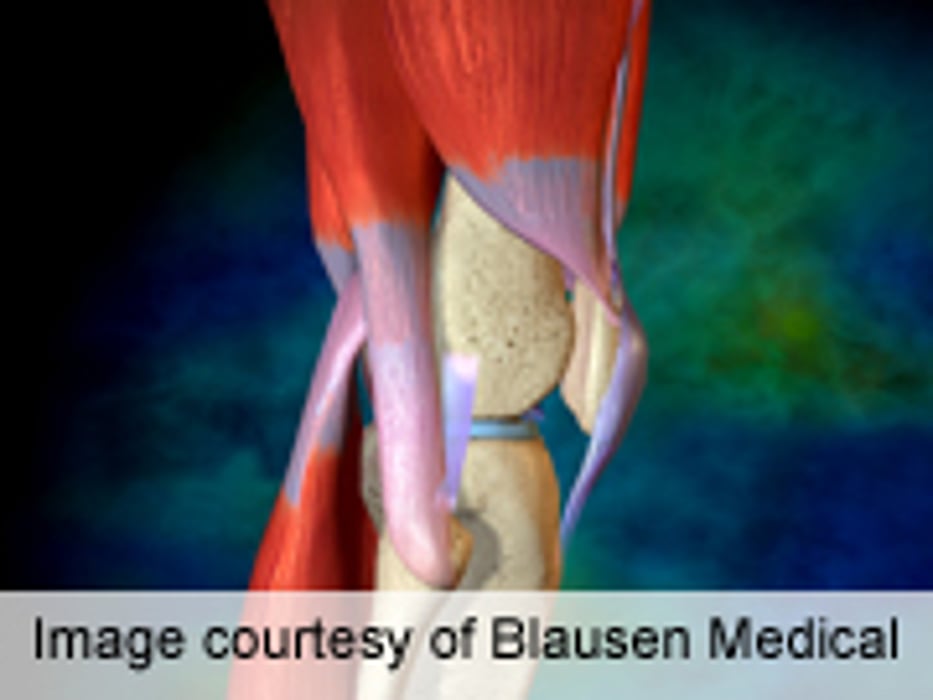 Return-to-Work Rate High After Knee Replacement, Study Finds