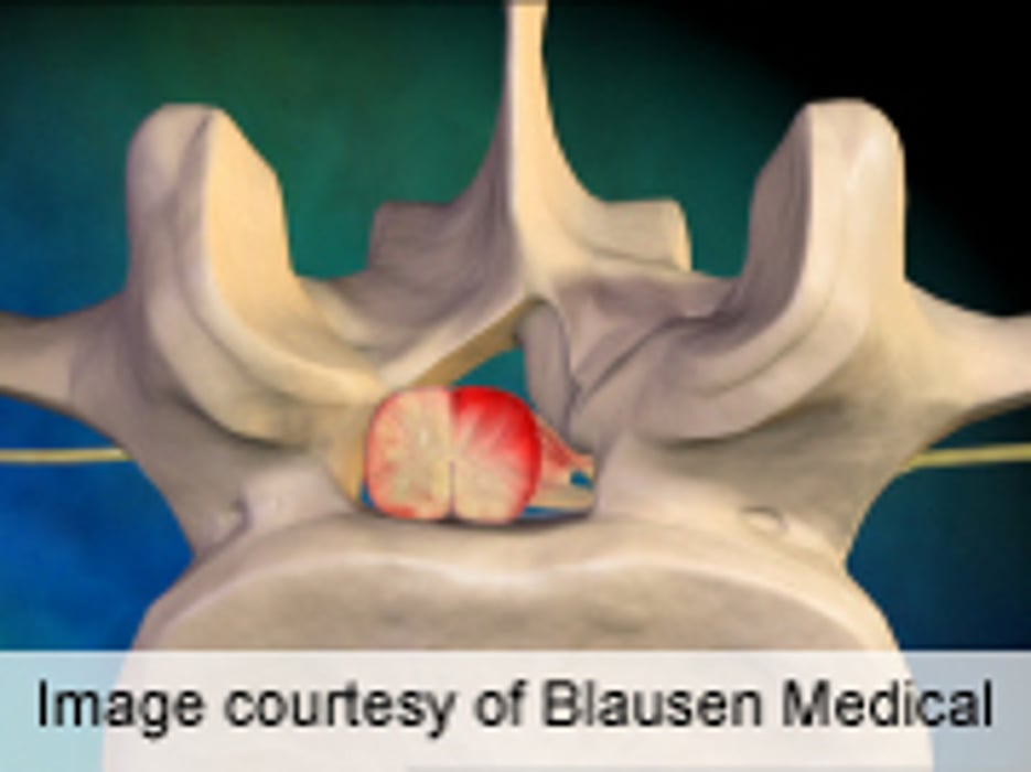 EP Studies Helpful in Lumbar Spinal Stenosis Prognosis