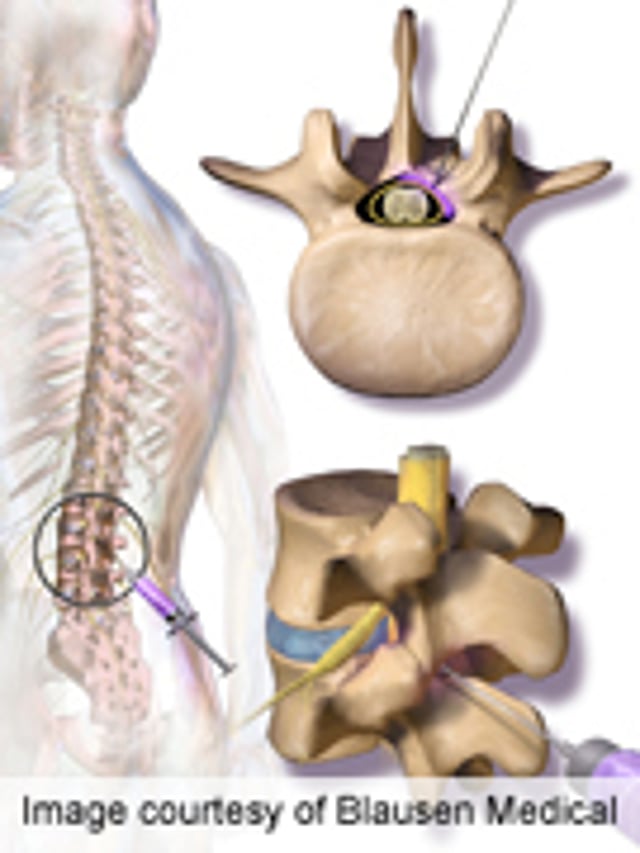 Steroid Injections May Worsen Spinal Stenosis Consumer