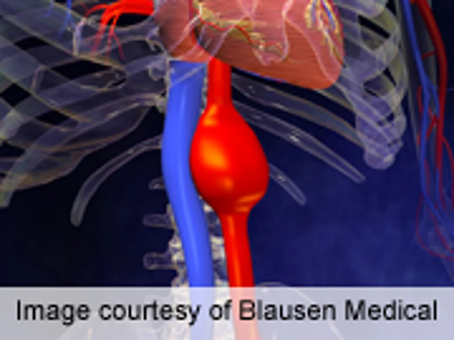 Better Ruptured Abdominal Aortic Aneurysm Outcomes in U.S.