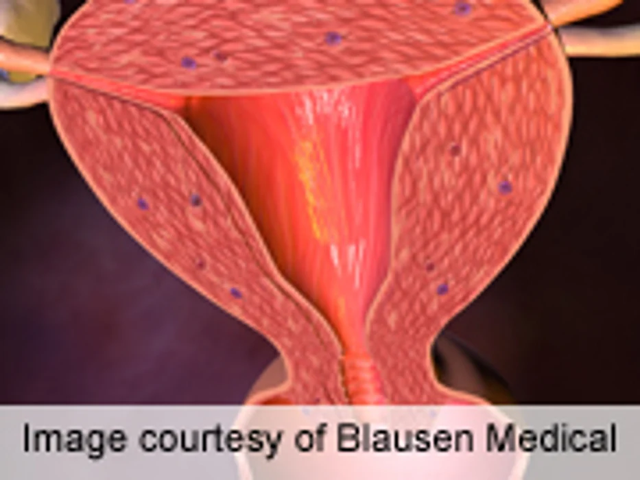 Keeping Fit May Boost Survival With Endometrial Cancer