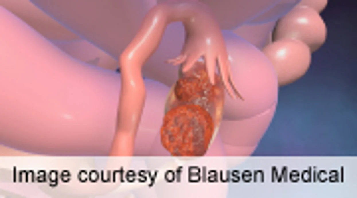 Study Provides More Data for Ovarian Cancer Risk Prediction
