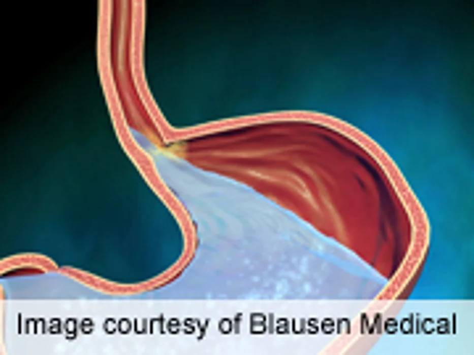 Positive Preclinical Results for Smo Inhibitor in Esophageal CA