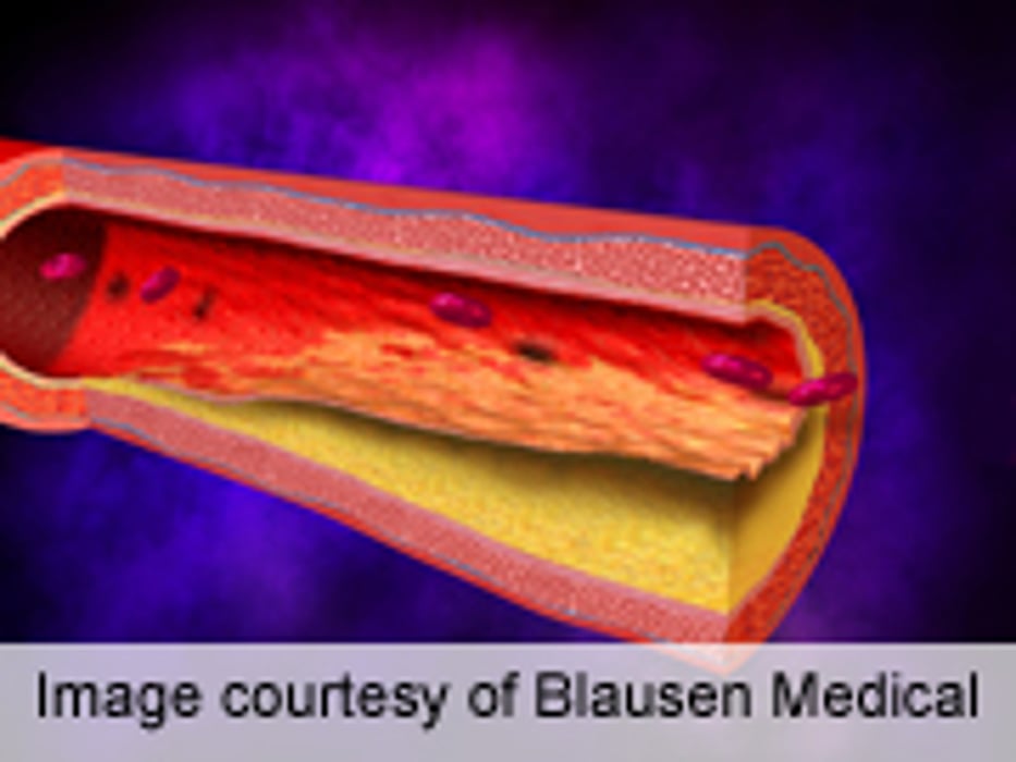 Atherosclerosis Seen in 8.5 Percent of U.S. Service Members