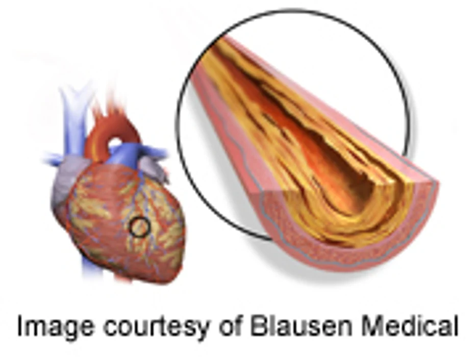 Vitamin D Not Tied to Subclinical Atherosclerosis in T1DM