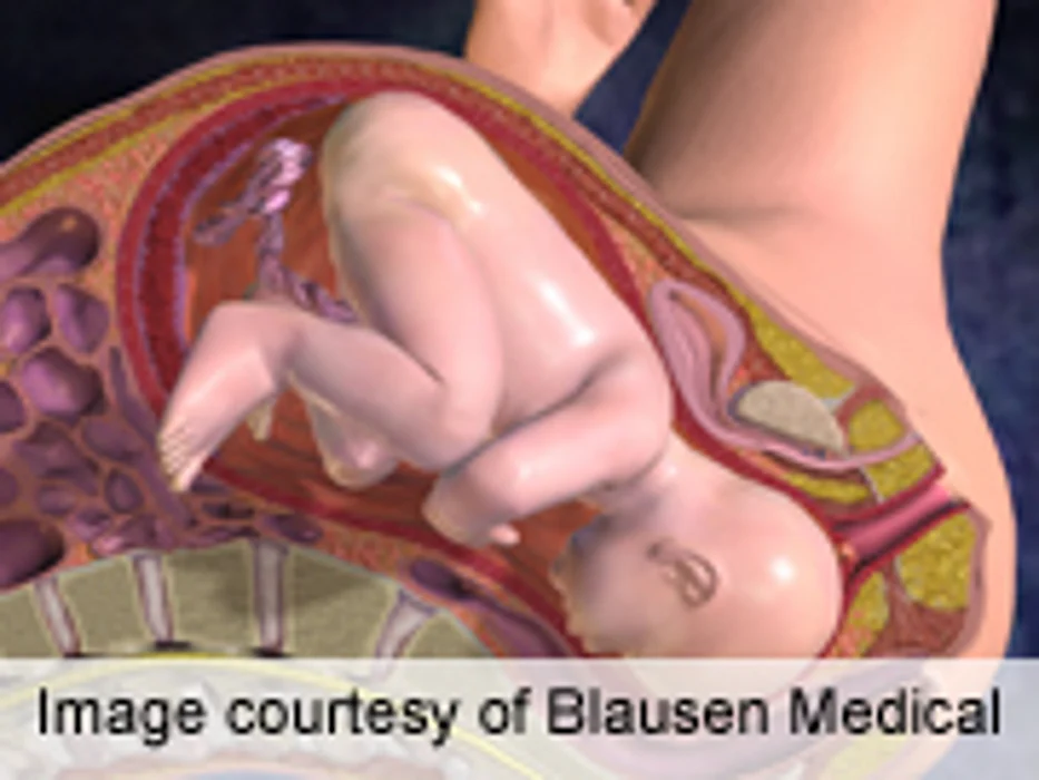 No Significant Link for Stillbirth, Maternal Antidepressant Use