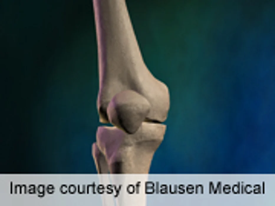 Knee Replacement Surgeries Rising With Obesity Rates